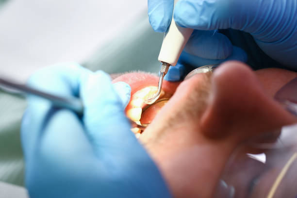 Best Emergency Wisdom Tooth Extraction in Deland Southwest, FL